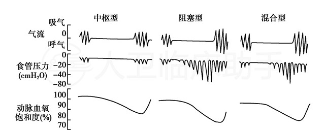 睡眠呼吸暫停有哪些類型