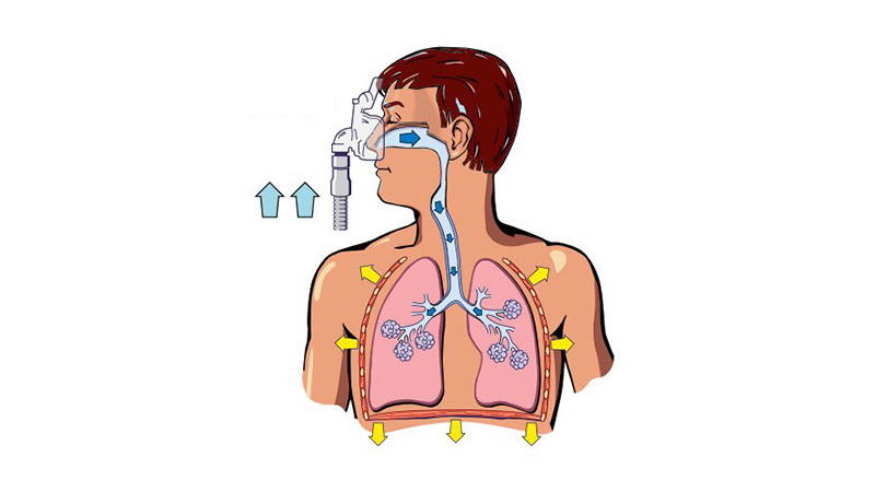 慢阻肺用呼吸機有用嗎?慢阻肺什么程度需要使用呼吸機?